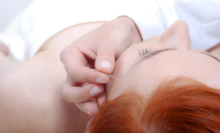 Acupuncture for migraines