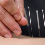 Acupuncture therapy