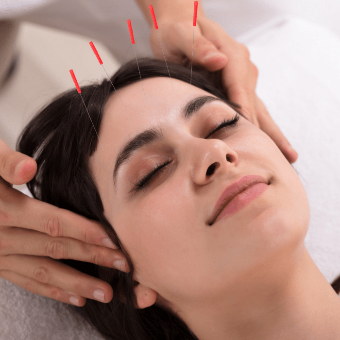 Acupuncture for migraines